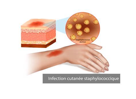 perte blanche infection|Leucorrhées : définition, symptômes et traitement